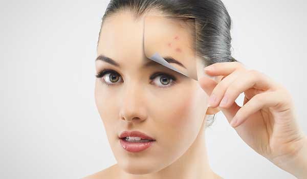 How To Care For and Prevent Pimples and Zits